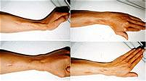 手良性骨肿瘤图片