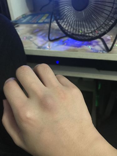 很我妈吵架一气之下头脑一热一拳锤墙上了,手肿了,就是有点疼但可以动