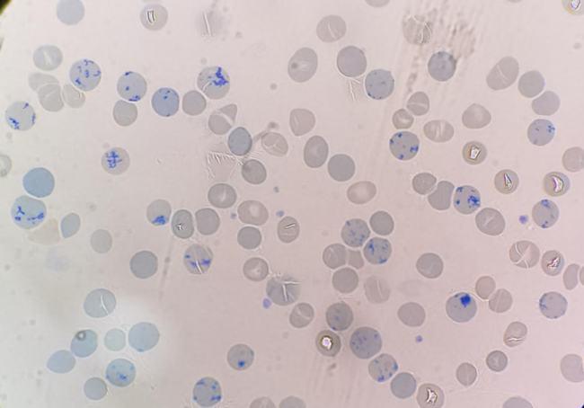 红细胞聚集导致的仪器法网织红细胞计数偏差一例