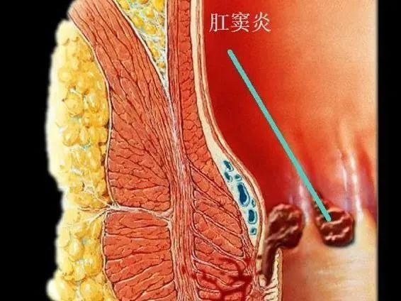 肛门疼痛的鉴别|脓肿|直肠|肛周|肛管_网易订阅