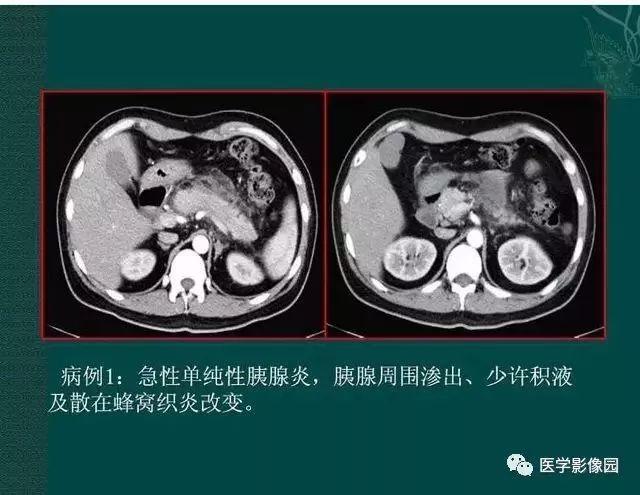 急性胰腺炎ct评价
