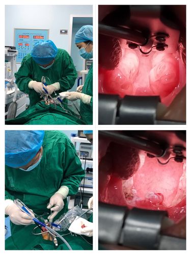 低温等离子射频消融微创手术~~~儿童扁桃体及腺样体切除的首选治疗!