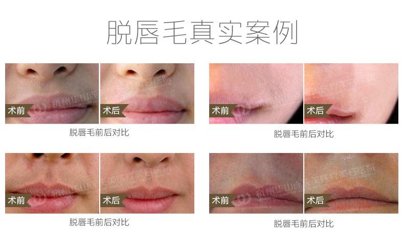 杭州激光脱毛 脱腋毛/唇毛