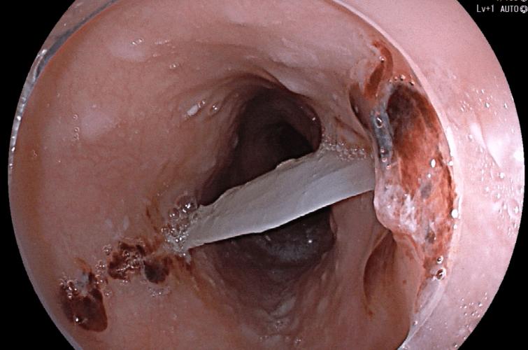 "祸"从口入,食管异物该如何是好?
