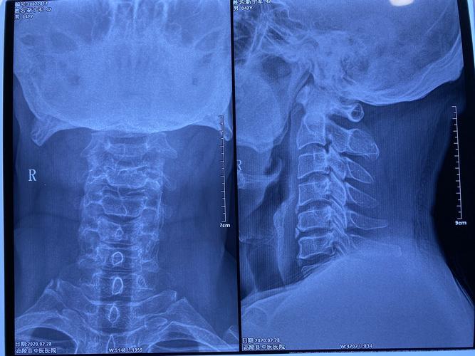 【高陵区中医医院】我院脊柱病科治疗脊髓型颈椎病的终极武器-颈椎