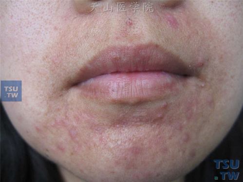 口周皮炎(perioral dermatitis)的症状表现