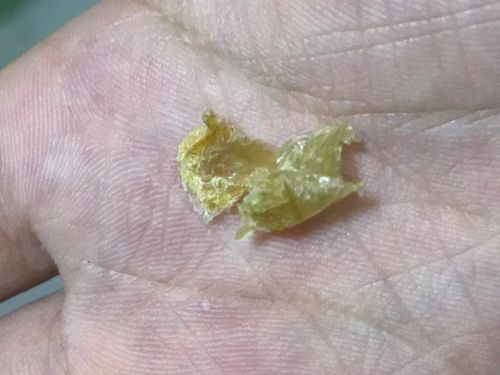 耳屎呈片状是怎么了?(图片会让人感到不适,慎点)