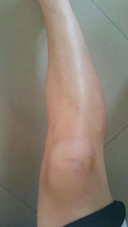 这小腿弯成这样 正常吗?