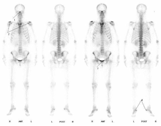 全身骨扫描报告解读一