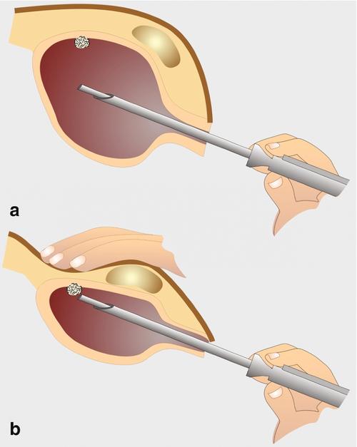 经尿道膀胱肿瘤切除术turbt