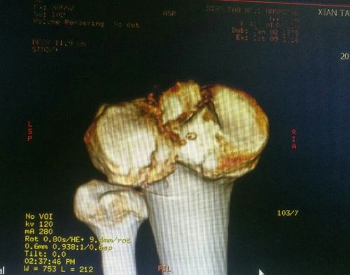 股骨内侧髁骨折,胫骨平台骨折,髁间嵴撕脱骨折.