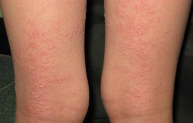 猩红热是一种什么病,严重吗?怎样治疗呢?