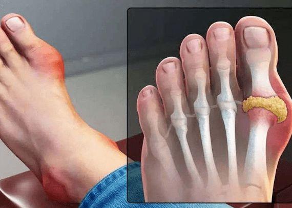 这4个变化或许是痛风的前兆你中招了