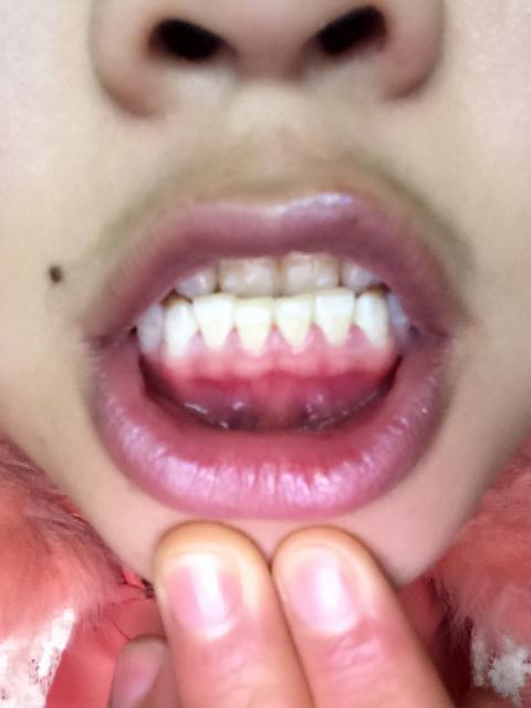我的牙龈怎么变成这样了麻烦专科医生帮我解答夏ltbr
