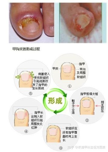 甲沟炎的预防护理收藏版