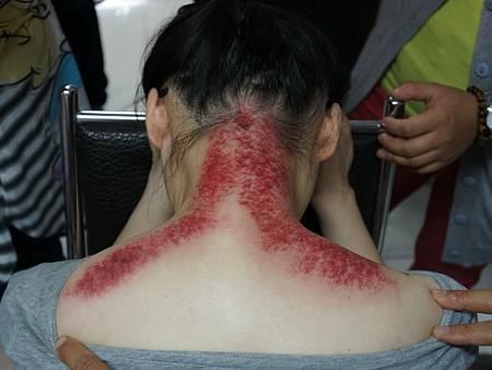 15别有病网第14期刮痧培训纪实