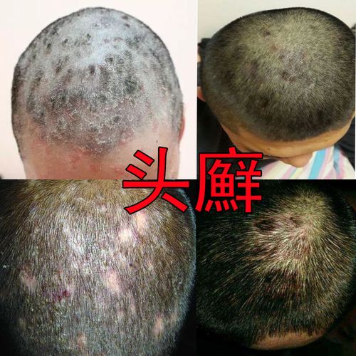 去头头皮屑头螨头癣控油螨虫结痂正品健安迪洗发水
