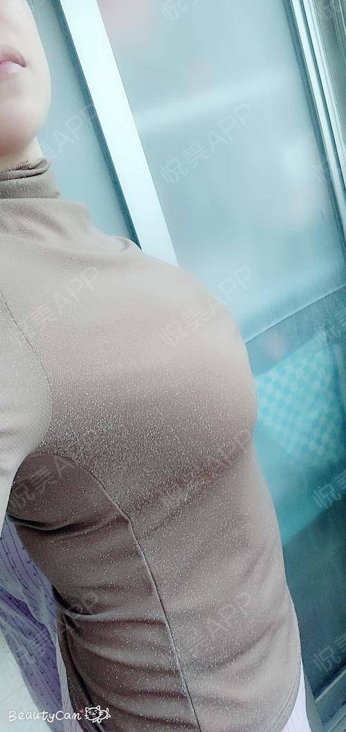 我做了大胸缩小,很多人不明白大胸的烦恼!特别是生完.