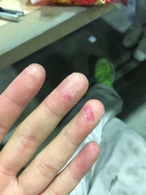 手蜕皮,发干,裂开了口子,剥脱性角质疏松症?