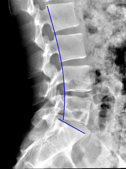 通过这两幅图可以看到,骶1的倾斜度与腰椎曲度的关联.