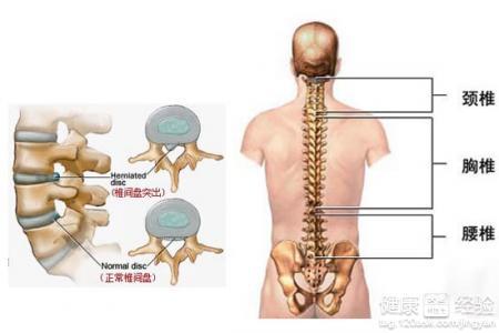 腰椎间盘突出的早期症状