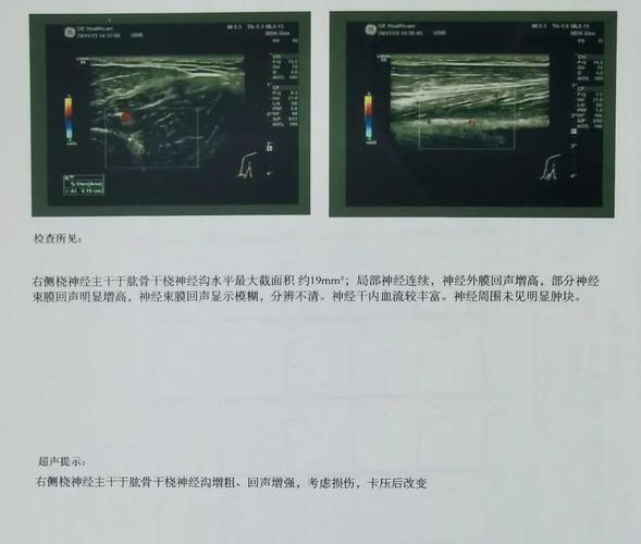 什么是桡神经损伤?