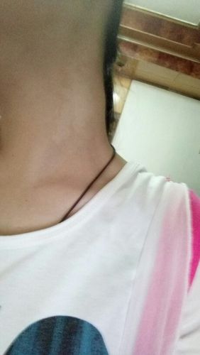 今天发现脖子后面 就是脖子转头右侧后方 有个地方鼓出来不转头看不出