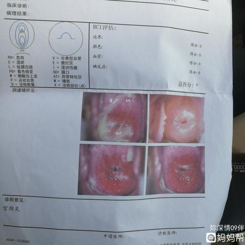 有谁懂得帮我看看,医生说是宫颈糜烂二度