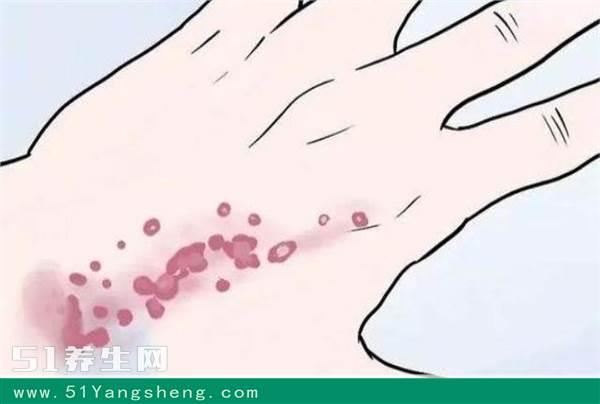 可能得白血病的7大"征兆",3分钟看完,马上学会简单自检识别!