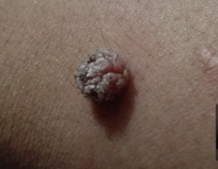 皮肤科的大神请进,手腕上长了一个肉瘤!