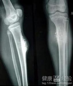 骨癌平时要注意些什么的好