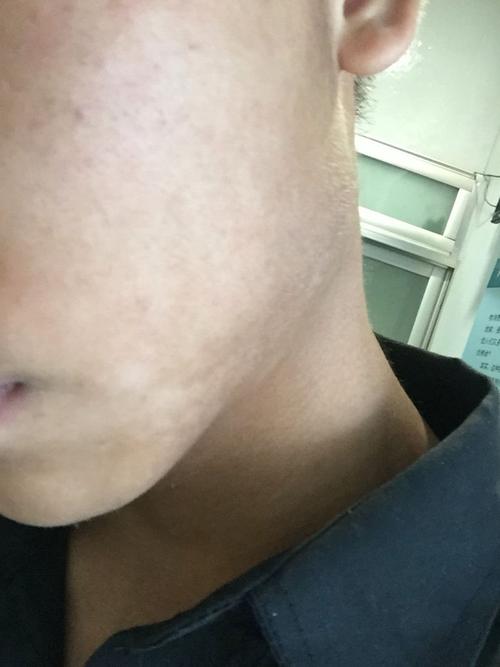 这是不是肚子里有蛔虫,脸上有白斑