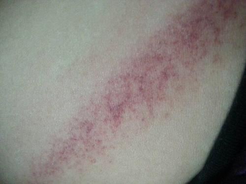 身上挠痒痒变红,帮我看看什么病