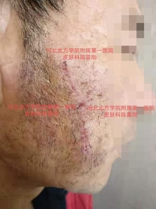 鲜红斑痣的手术切除