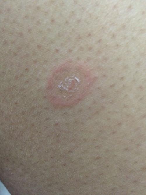 身上起个圆圈,然后皮发皱还掉皮,有点小痒痒,想问问怎么回事