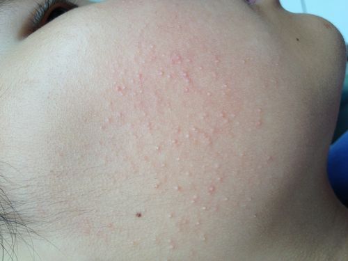 约半年面部小丘疹,请帮助诊断