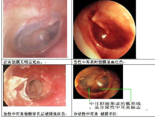 急性化脓性中耳炎
