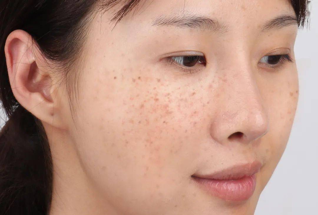 脸上长斑别瞎治皮肤科医生再三建议每个女人都要注意