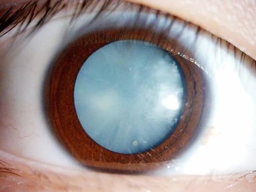 15岁男生拿可乐当水喝,得了白内障,右眼几乎完全失明!