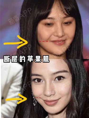 不断层的苹果肌才是少女感的关键75157515肌