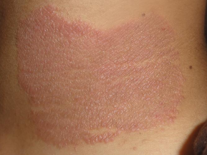 颈侧神经性皮炎