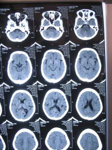 如何读脑梗ct片?(如图)请教,谢谢!