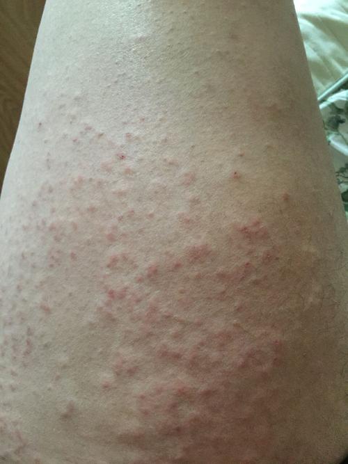 百度了湿疹,和湿疹很相似请问是什么?用了派瑞松