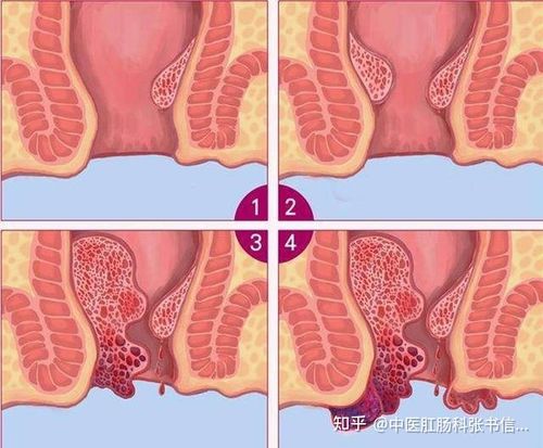 ii度型痔疮   排便时自行出血,而且伴有痔物脱出,在大便完成后这种