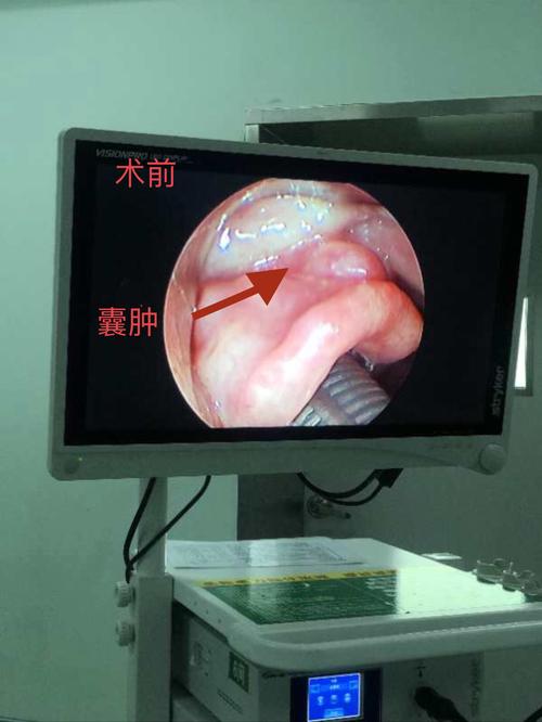 其它 等离子消融术的扩展应用 写美篇 今天上午一例会厌囊肿的患者,在