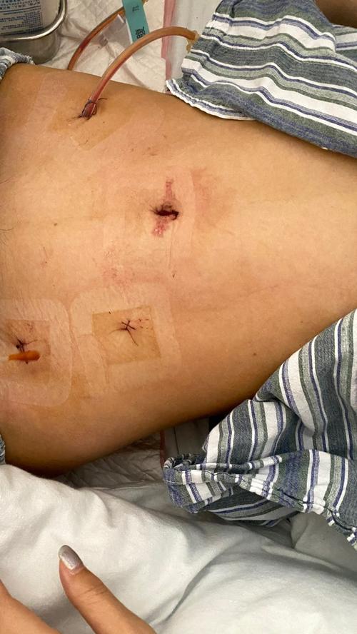 28岁宫外孕 我的腹腔镜手术历程