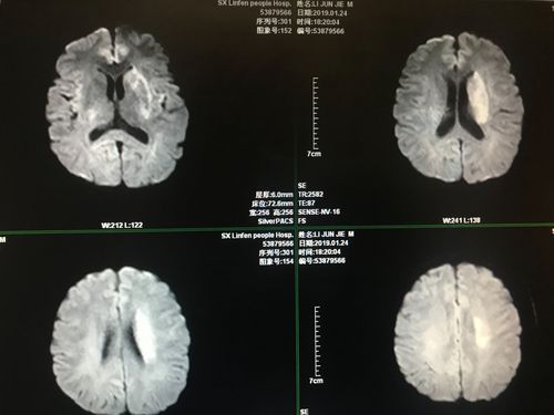 mr:见左侧脑室旁脑梗塞.