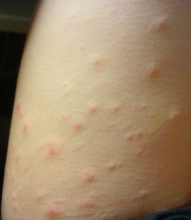 身上冒出很多红疙瘩!(有图.)怎么回事啊啊啊啊!