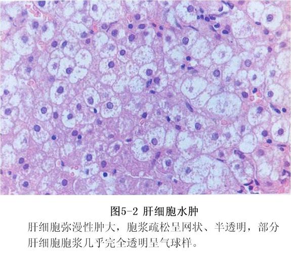 细胞水肿-延安大学医学院病理学