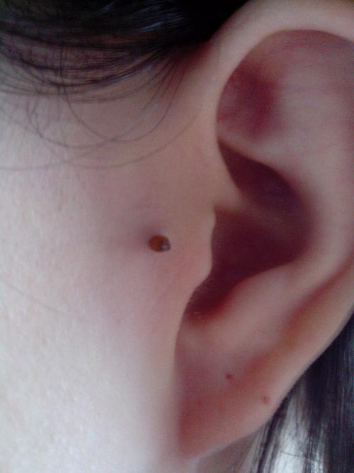 开始平平的 后来突出一小块 最后鼓起一个包 一直以为是左耳的骨头有